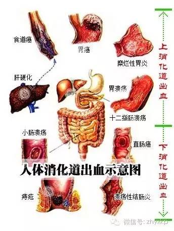 肝硬化上消化道反复出血咋办,肝硬化消化道出血能喝牛奶吗