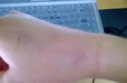 银杏果为什么使人中毒了,银杏果中毒真的假的