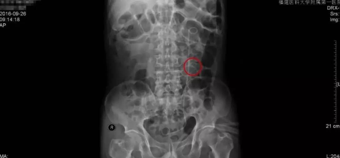 23岁男性泌尿道结石治疗方法,中医治疗输尿管结石独特方法