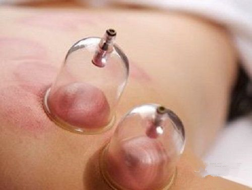 根据拔罐后皮肤的颜色鉴定你的身体到底是怎么了