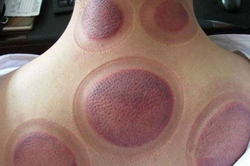 根据拔罐后皮肤的颜色鉴定你的身体到底是怎么了