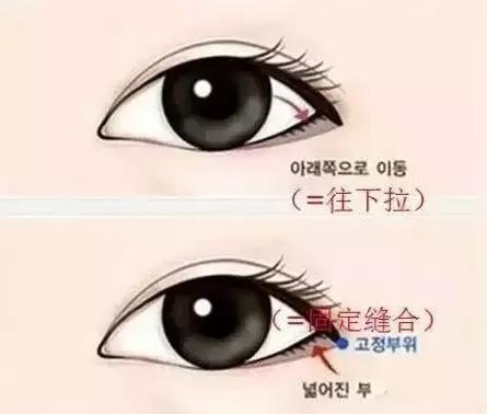 什么人适合开内眼角和外眼角,每个人都适合开外眼角吗