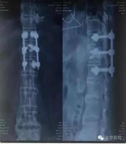 北京腰椎骨折微创手术,北京骨科大腿骨头骨折手术