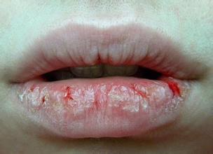 冬季孩子嘴唇红肿干裂老是舔,冬季嘴唇干裂破皮出血怎么办