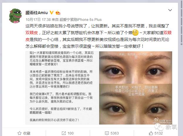 双眼皮变脸真实案例,网红双眼皮最成功的