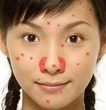 突然长很多痘是有什么病吗,3种长痘的原因了解一下你中了吗