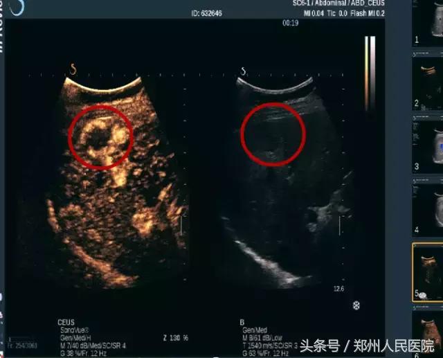 超声造影你了解多少,超声造影什么意思