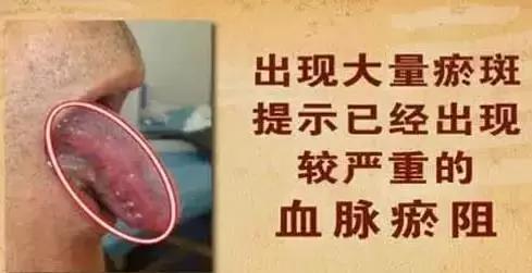 舌头不好,心室不好会导致舌头有哪些症状