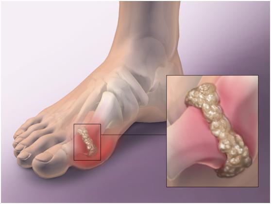 早期痛风怎么治才能断根,突然痛风一招解决