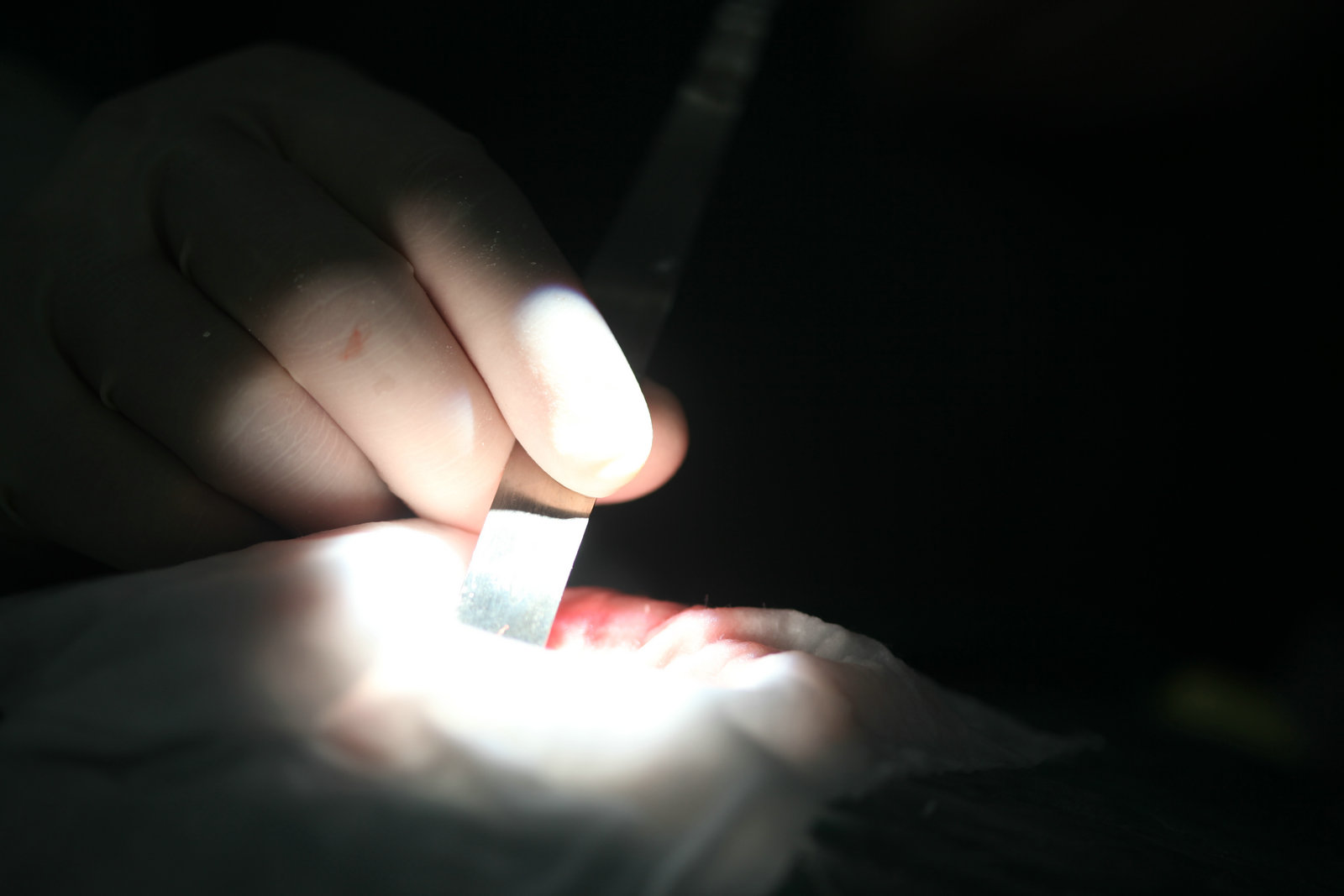 神经外科纪实视频,显微神经外科手术费用