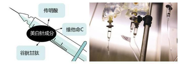 打美白针要知道哪些常识,打美白针要注意这些事项