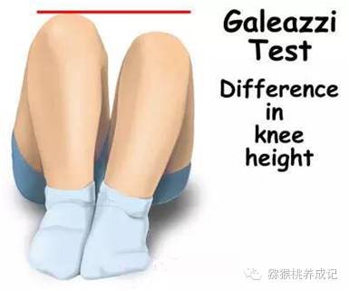 大腿纹不对称图片大全,新生儿大腿皮纹不对称怎么办