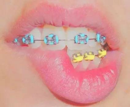 关于牙套上的橡皮筋，你需要知道的都在这