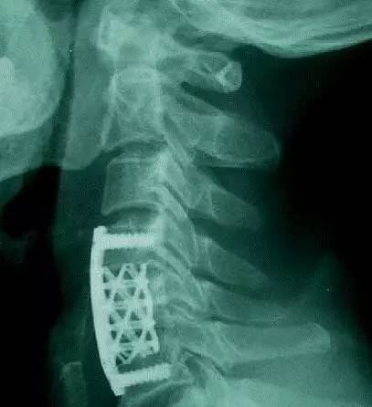 北医三院首例3d打印脊柱怎样了,3d打印助力攻克骨科难题