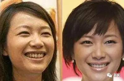 林允整牙却像整容？她是真的又整了啊！