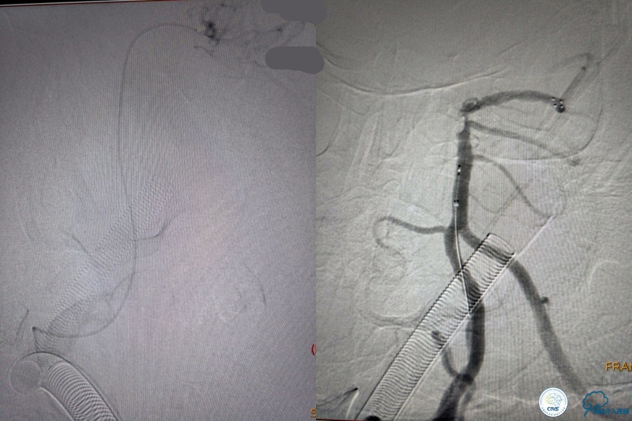 一例急性基底动脉尖综合征患者的支架取栓治疗