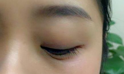 双眼皮“留疤”要多难看多难看，如何防止，留疤如何挽回？