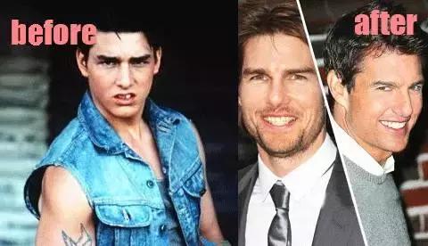 整牙=整容？看杨幂、刘涛、高圆圆为你亲身示范！