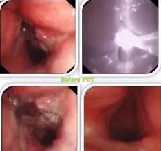 成都光动力治疗肿瘤专家有哪些,光动力治疗肿瘤的研究背景