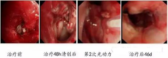 成都光动力治疗肿瘤专家有哪些,光动力治疗肿瘤的研究背景