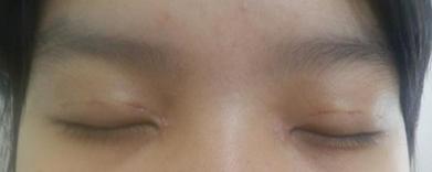 双眼皮“留疤”要多难看多难看，如何防止，留疤如何挽回？