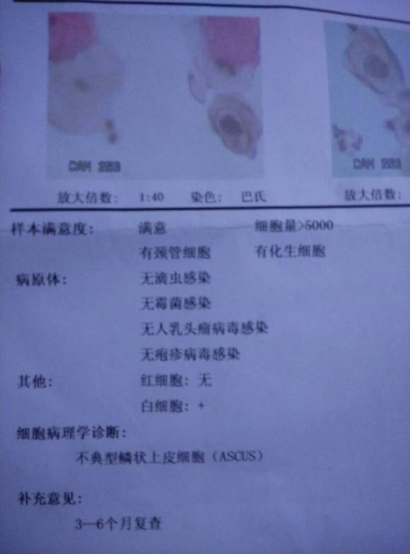 宫颈癌筛查tct正常报告单,宫颈癌筛查报告单怎么看tct