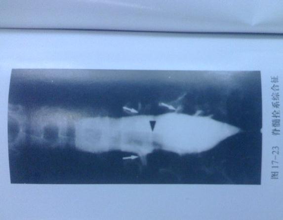 脊髓栓系综合征术后怎么锻炼脚,脊髓栓系手术后怎么减轻疼痛