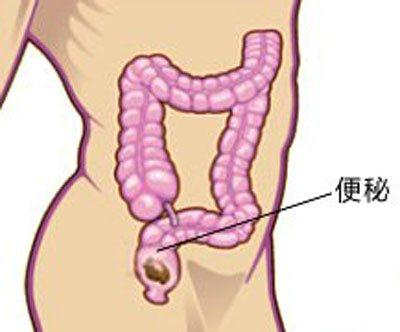 产后痔疮便血疼痛吗,母猪产后便血怎么治