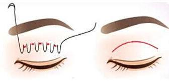 割双眼皮选医生真实经验分享,割双眼皮不能不知道的7个潜规则