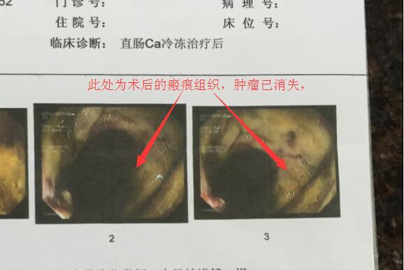 低位直肠癌保肛冷冻治疗多少费用,低位直肠癌患者保肛后存活率