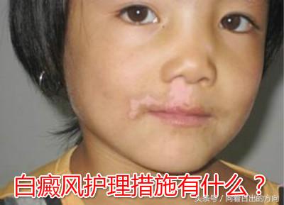 单侧白癜风反反复复特点,科学治疗白癜风拒绝白斑反反复复