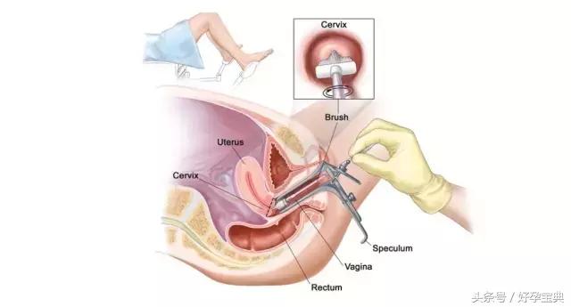 妇科检查前需要注意的事项,妇科支原体检查前要注意什么