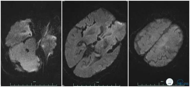 CINS2016病例展｜一例双侧大脑前动脉栓塞的再通治疗