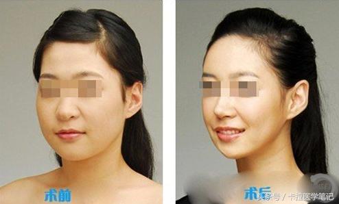 我想知道怎么进行吸脂减肥,想减肥不一定非要做手术吸脂