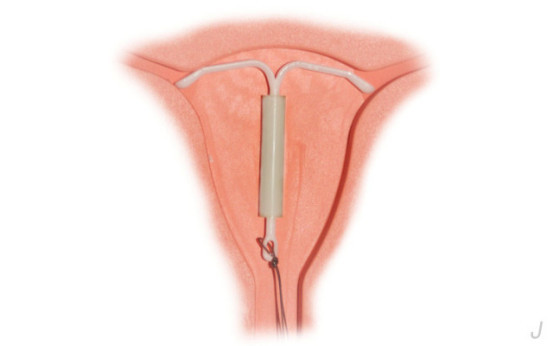 取节育环的最佳时间和注意事项,节育环不取后果