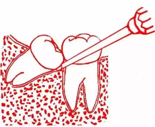 智齿的治疗过程,智齿要上下成对拔除吗