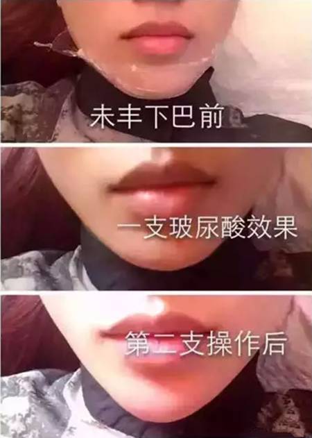 玻尿酸填充下巴一针还是两针好,玻尿酸丰下巴后要注意哪些问题