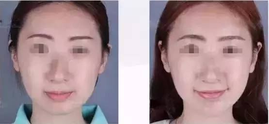 玻尿酸填充下巴一针还是两针好,玻尿酸丰下巴后要注意哪些问题