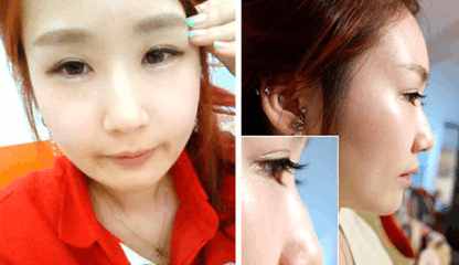 韩式隆鼻因为“韩式”价格翻番，汇总你都踩过多少坑？