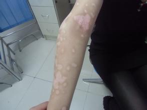 uvb和308治疗白癜风哪个效果好,家用308治疗白癜风哪个品牌好