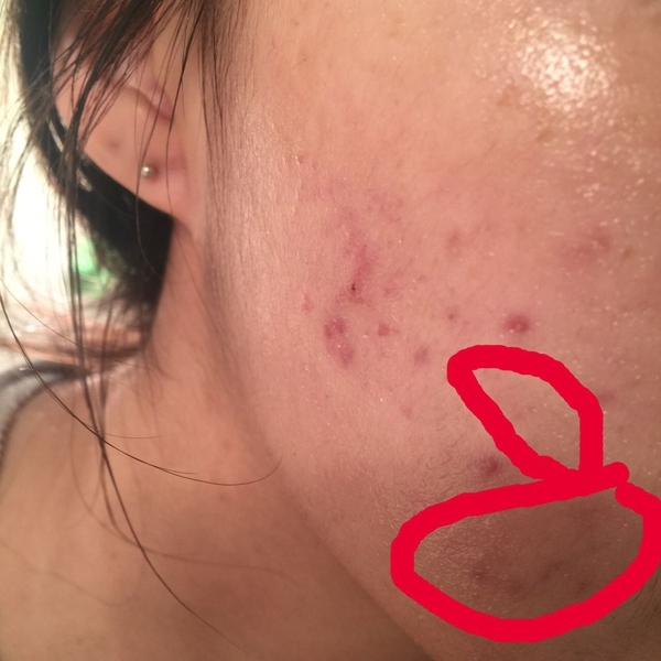 变美还是要祛痘,变美第一步祛痘