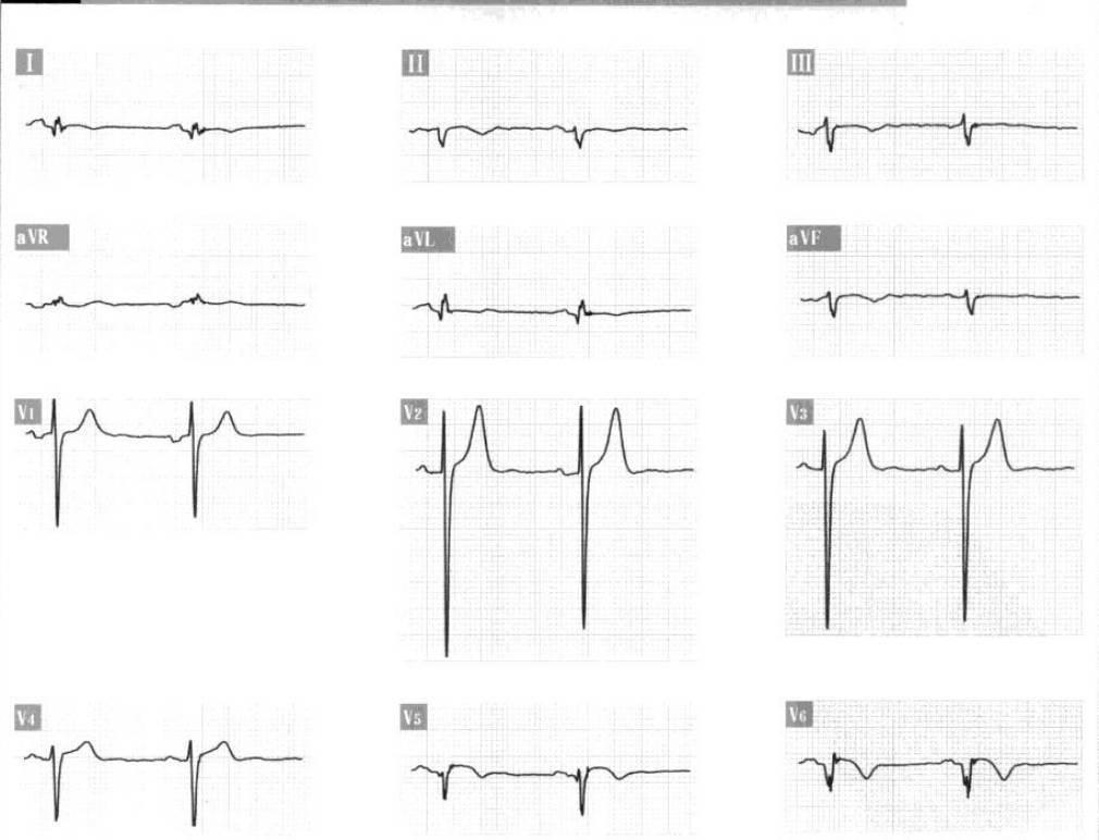 心电图出现异常q波说明心肌缺血,心电图v1v2q波异常严重吗