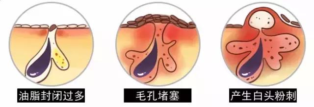 angelababy痘痘,angelababy额头冒巨痘