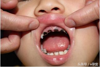 口腔科主任告诉您：儿童如何有效防止蛀牙