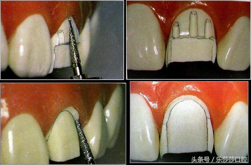 为什么牙医爱忽悠人做烤瓷牙,牙医的真相大全