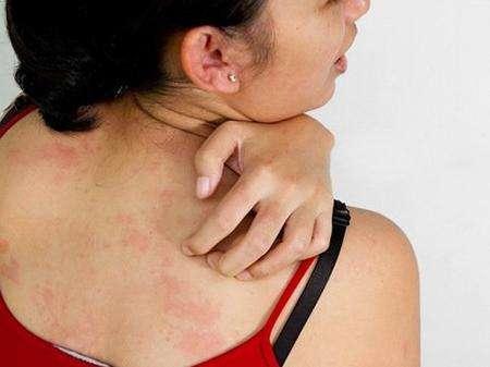 孕妇妊娠瘙痒,孕妇瘙痒症的症状