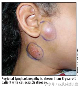 有没有被猫抓过，那你可要留意一下这个皮肤病了，猫抓病