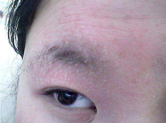 春季干燥红血丝肌肤该如何补水,冬季皮肤干燥怎么正确给肌肤补水