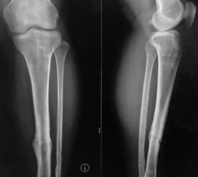 骨折内固定伤口处流脓是为什么,骨折固定支架外部流脓怎么处理