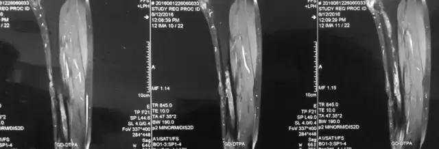 骨折内固定伤口处流脓是为什么,骨折固定支架外部流脓怎么处理